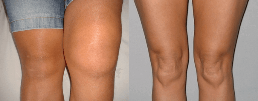 Erfahrungen mit der Verwendung von Cannabisöl-Kapseln vor und nach der Anwendung von Eva